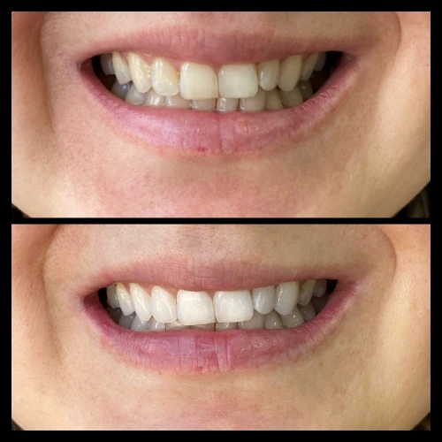 Blanqueamiento dental