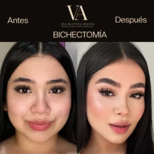 Bichectomía