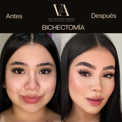 Bichectomía
