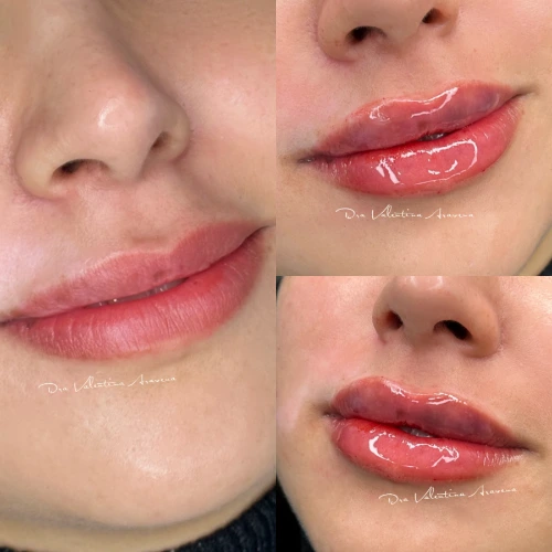 Aumento de labios