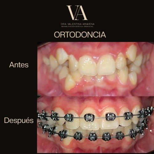 Smart Ortho Adhesivo para Ortodoncia Smart Dent