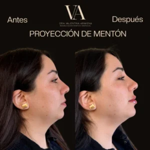 Proyección de mentón