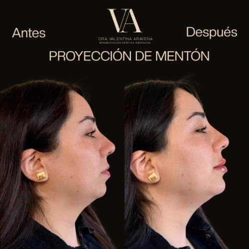 Proyección de mentón