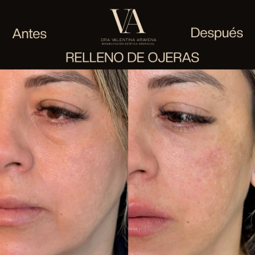 Relleno de ojeras