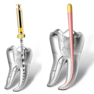 Retratamiento de Endodoncia
