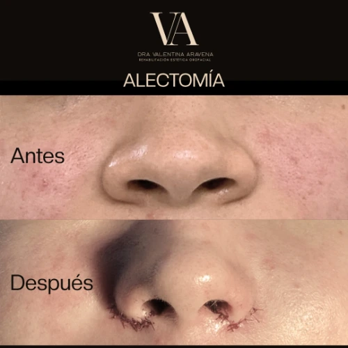 Alectomía